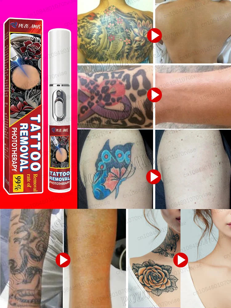 Tattoo Removal Laser Pen, suitable for tattoos of all sizes, effectively removes permanent tattoos. Innova Techno