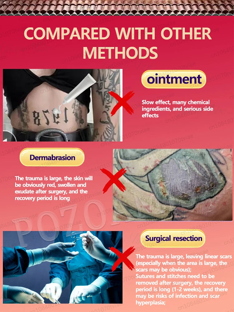 Tattoo Removal Laser Pen, suitable for tattoos of all sizes, effectively removes permanent tattoos. Innova Techno
